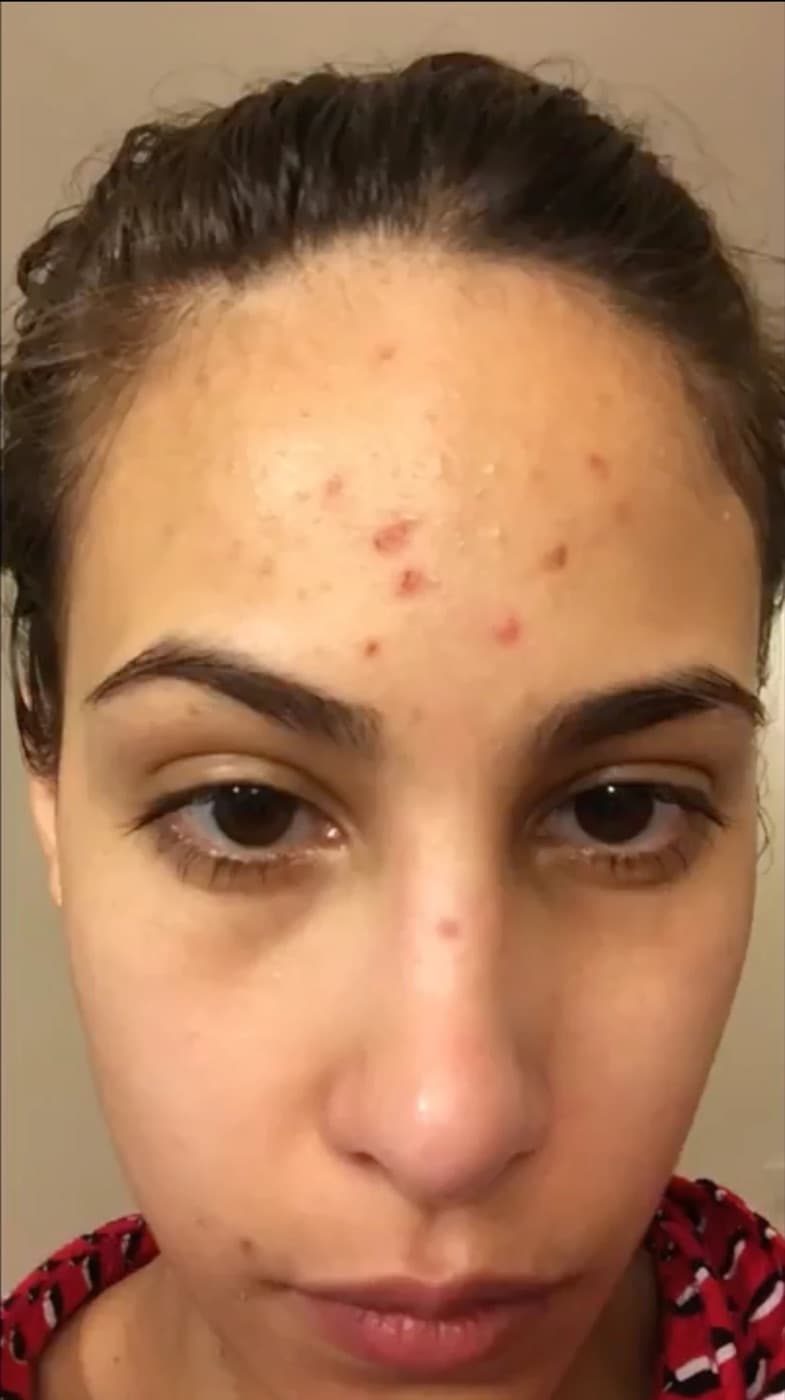 Melissa, forehead with picked spots