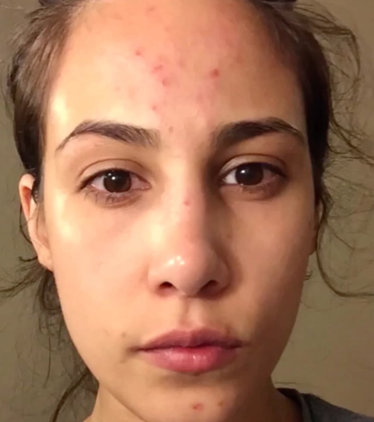 Melissa, forehead and nose with picked spots