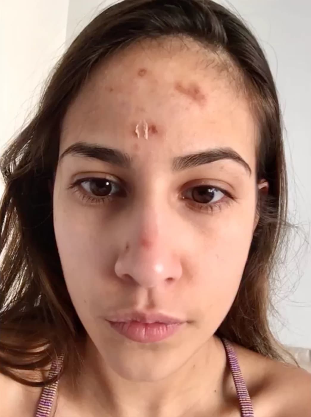 Melissa, healing marks on forehead and nose